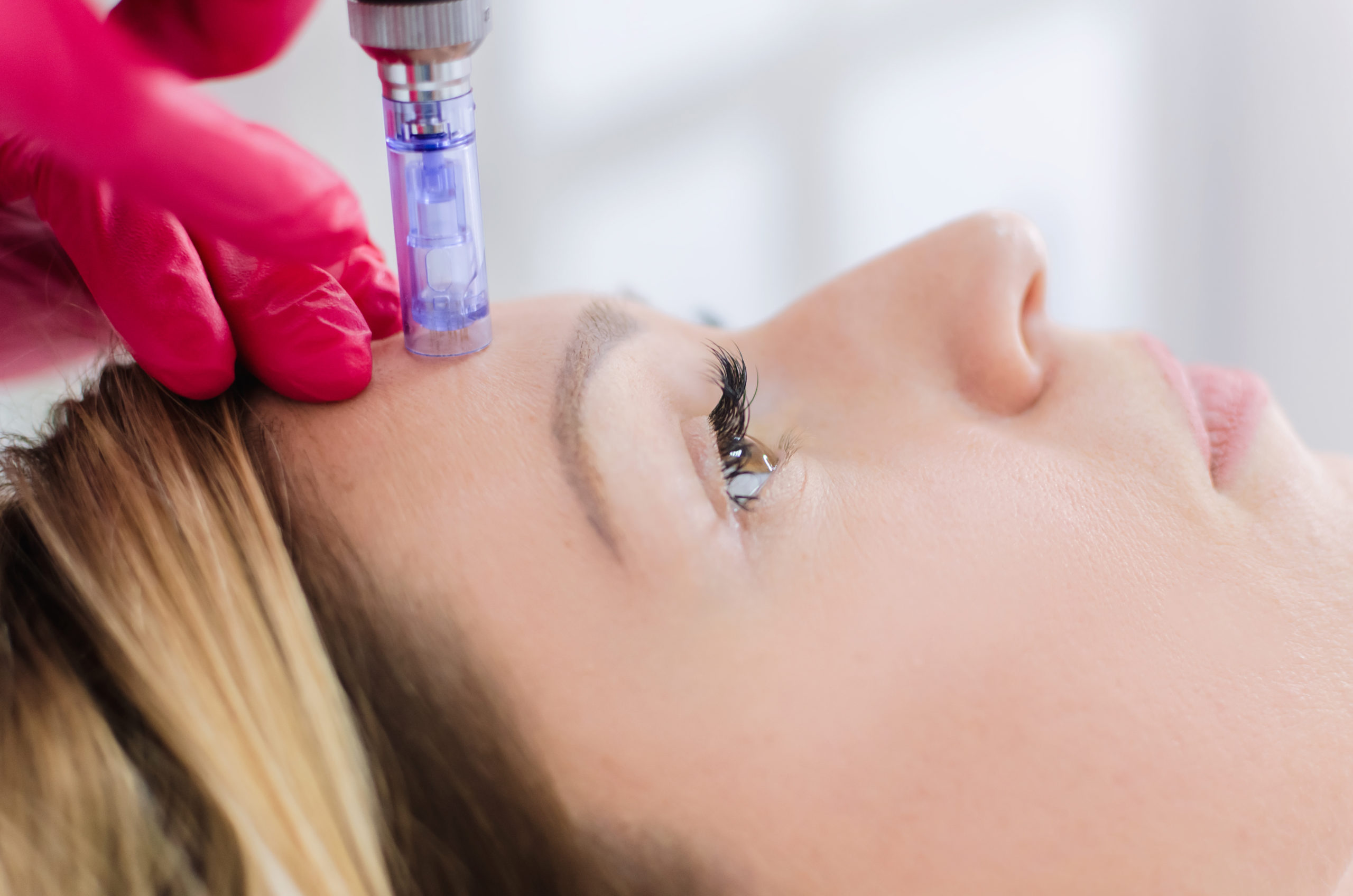 professional microneedling