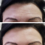 Forehead wrinkles reduced
