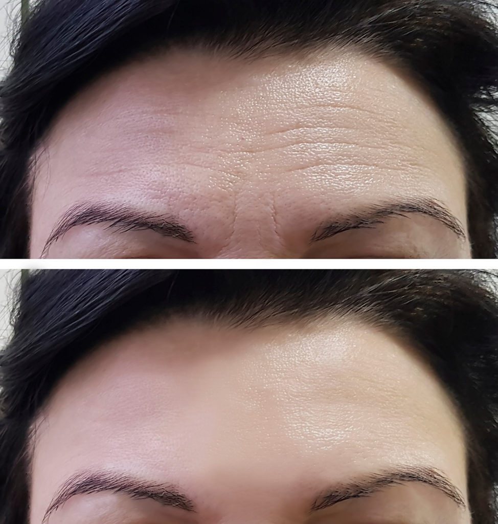Forehead wrinkles reduced