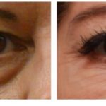 before and after eye bags